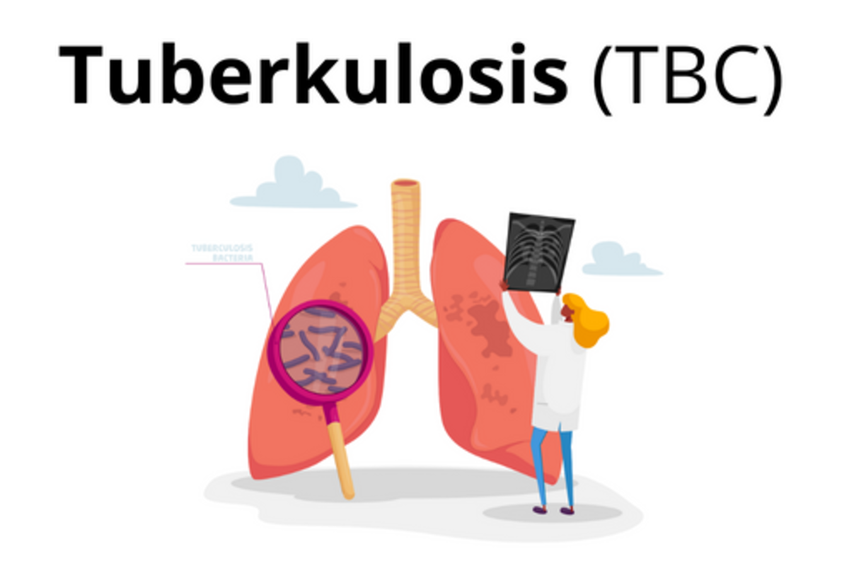 5 Faktor Penyebab Penyakit TBC dapat Menyerang Remaja dan Anak Muda