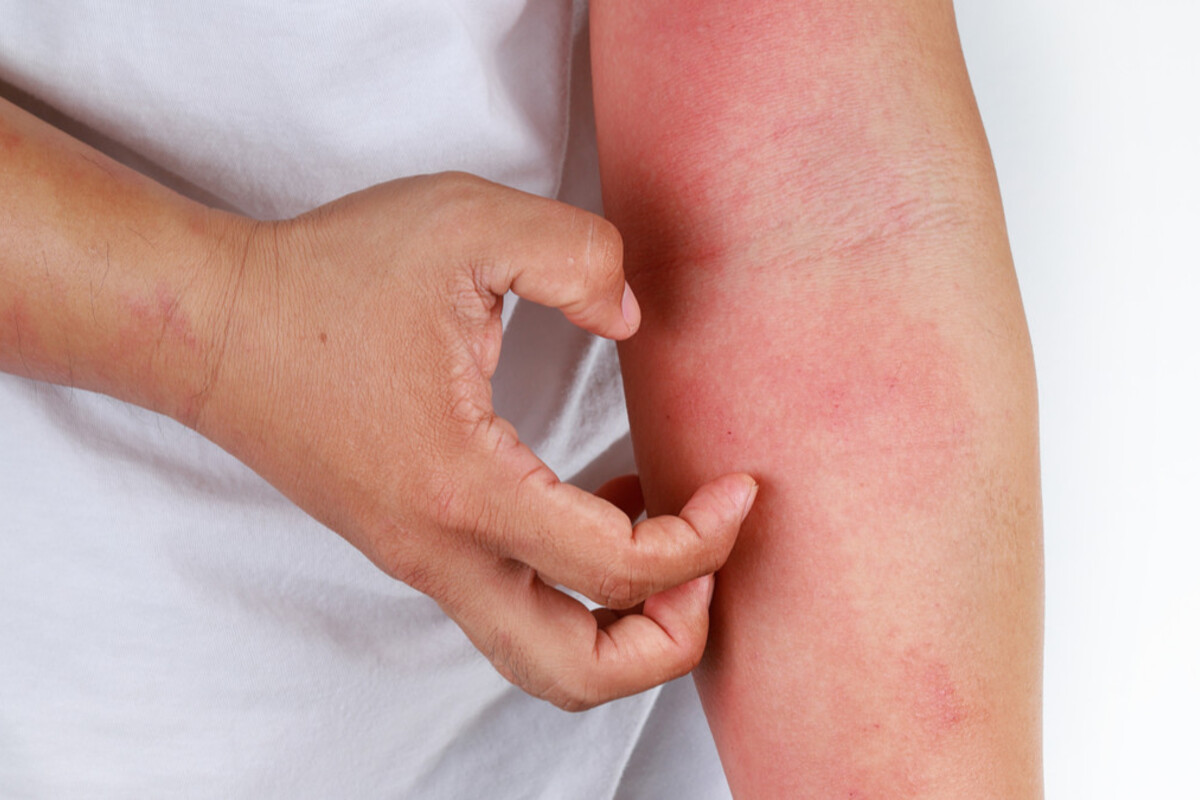 Yuk Kenali Bersama, Inilah 4 Penyebab Alergi yang Perlu untuk Diketahui