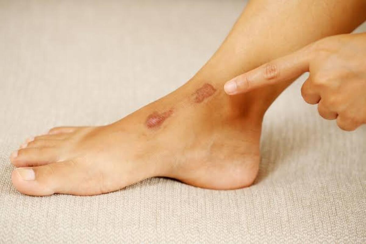 8 Cara Mudah Mengatasi Kaki Korengan Agar Kembali Lembut dan Sehat