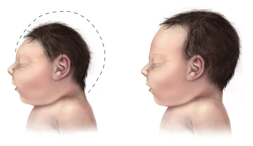 Microcephaly-comparison-500px