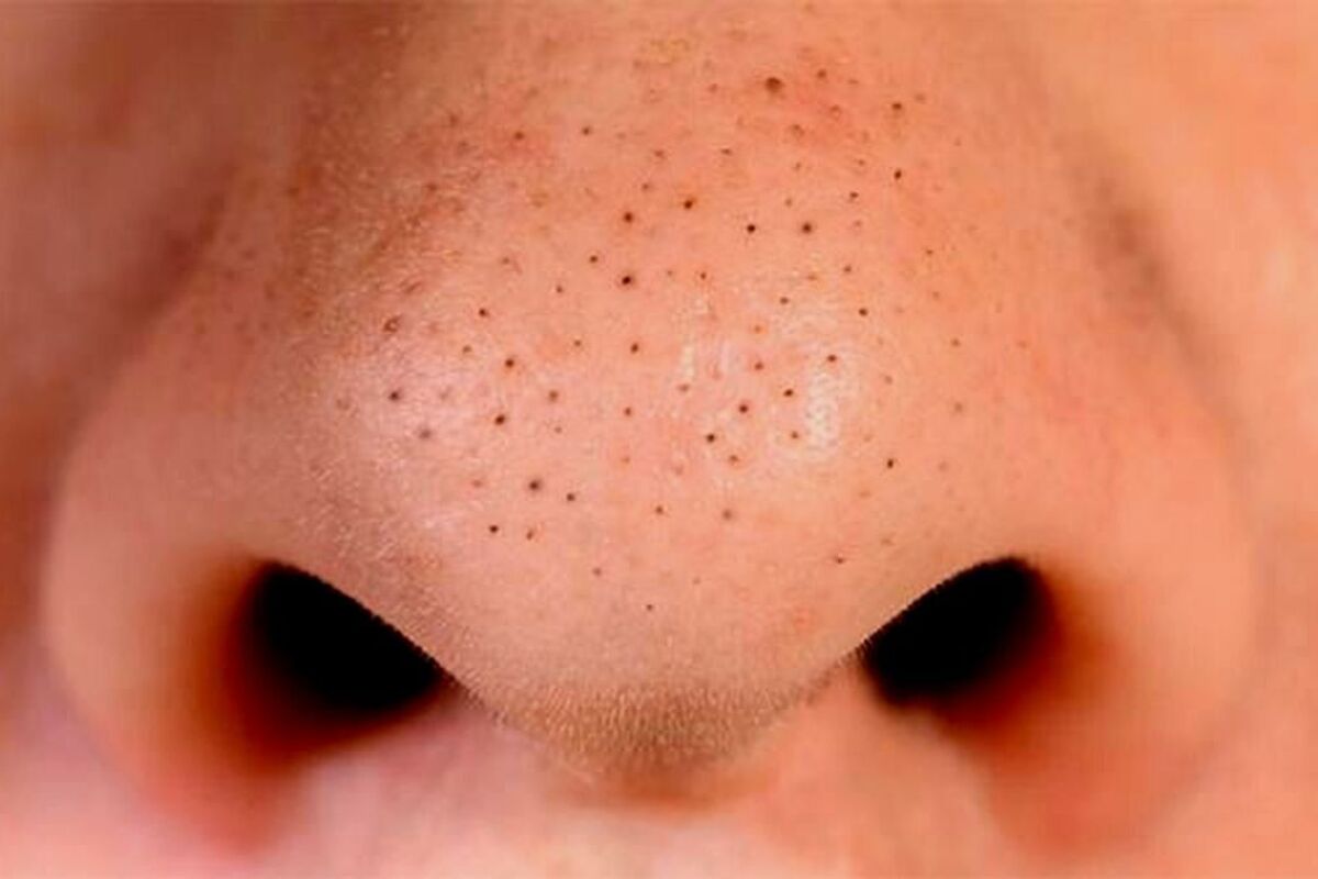 Tips Menghilangkan serta Mencegah Munculnya Komedo di Hidung
