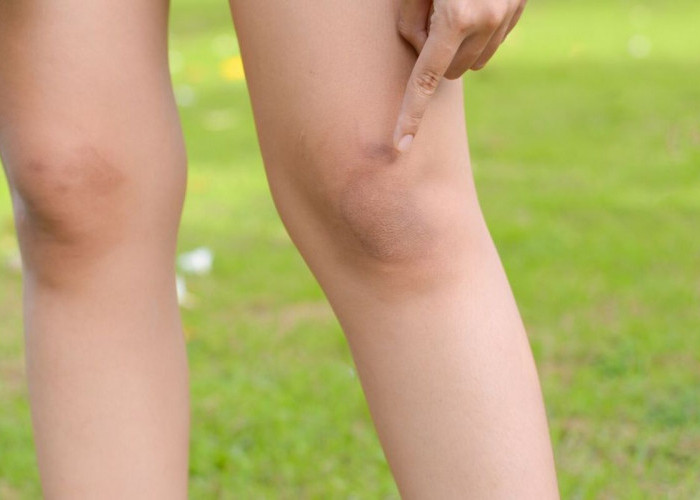 4 Cara Memutihkan Lutut dan Siku yang Dijamin Ampuh