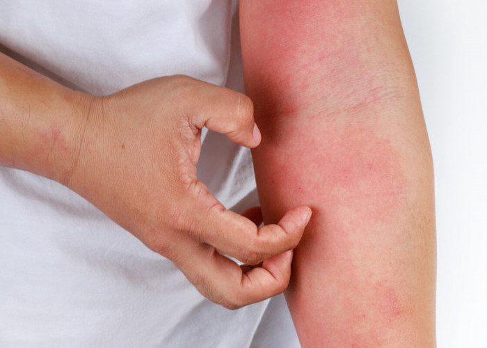 Yuk Kenali Bersama, Inilah 4 Penyebab Alergi yang Perlu untuk Diketahui