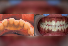 Gusi Berdarah Dan Bau Mulut? Jangan-Jangan Karang Gigi Biang Keroknya!